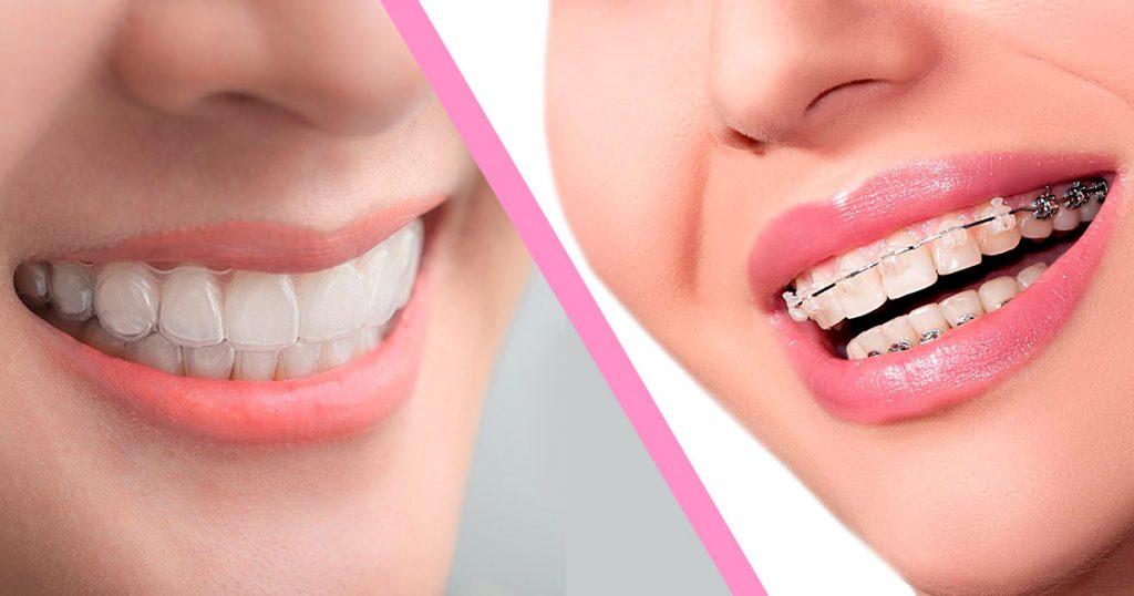 difference-between-invisalign-and-braces