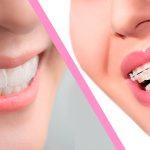 difference-between-invisalign-and-braces