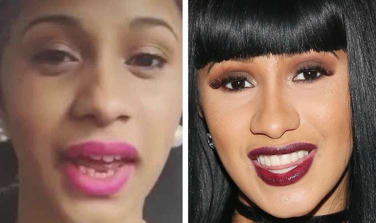 Cardi B veneers