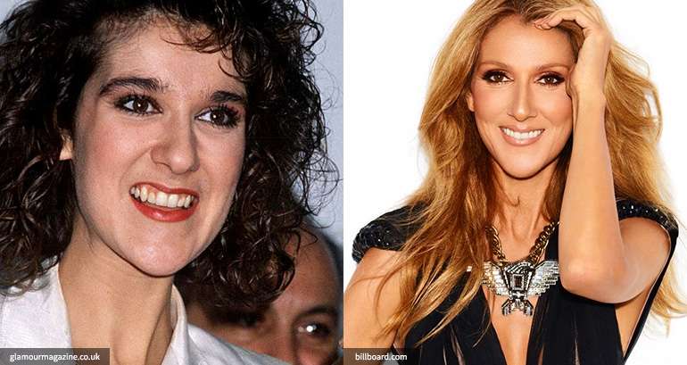 Celine Dion veneers