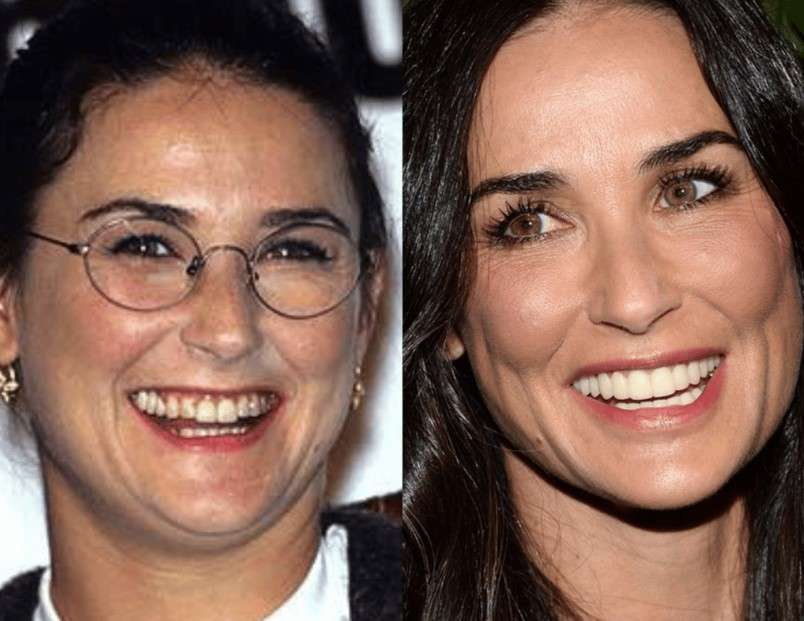 Demi Moore veneers