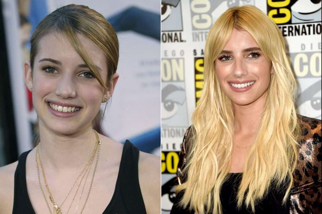 Emma Roberts veneers