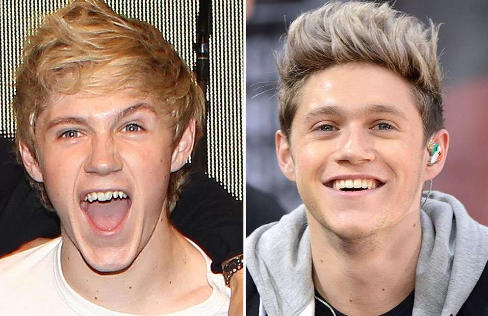 Niall Horan veneers