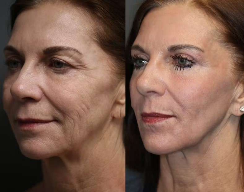 before and after thread lift