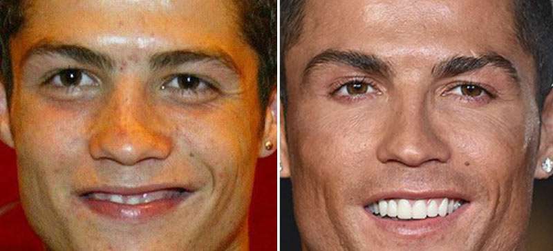 cristiano ronaldo veneers