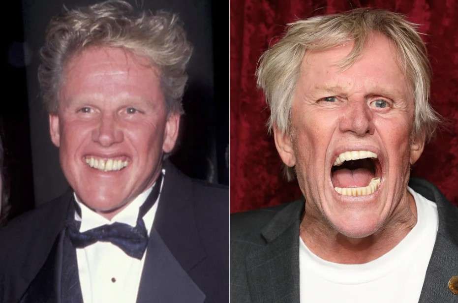 gary busey veneers