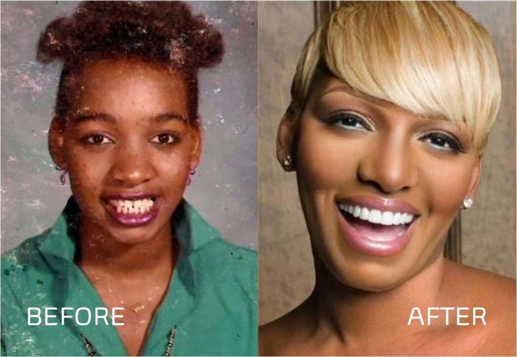 nene leakes veneers