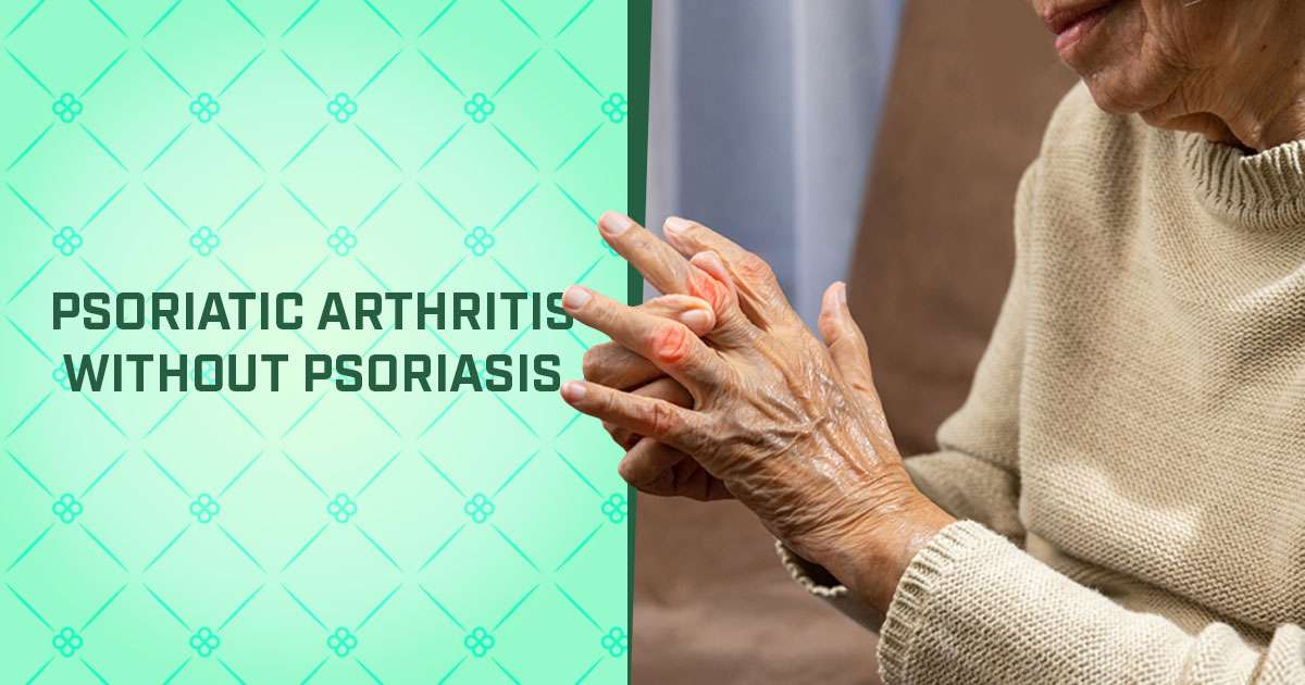 psoriatic arthritis without psoriasis