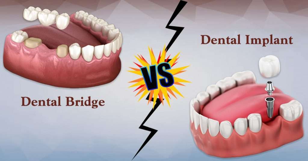 Dental Bridge vs. Implant: Pros & Cons