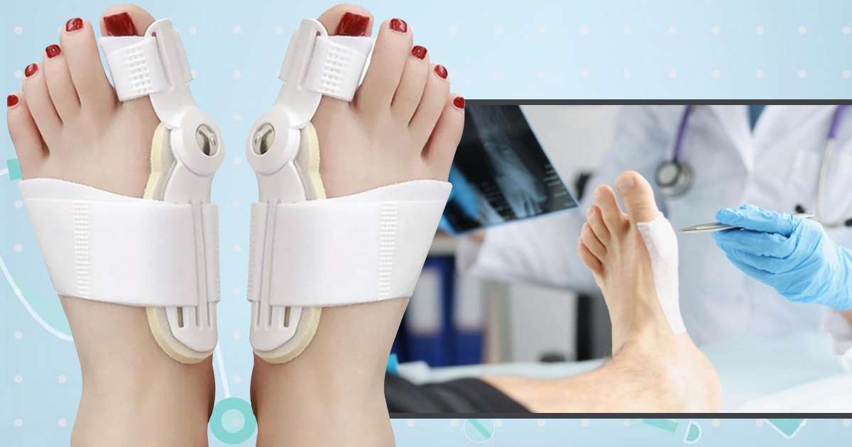 bunion removal surgery cost