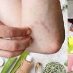 get rid of bug bite scars