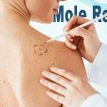 cost to remove mole