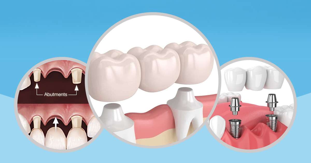 how-long-does-a-dental-bridge-last