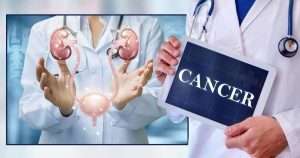 bladder cancer prevention