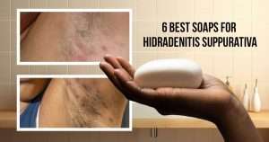 6 best soaps for hidradenitis suppurativa